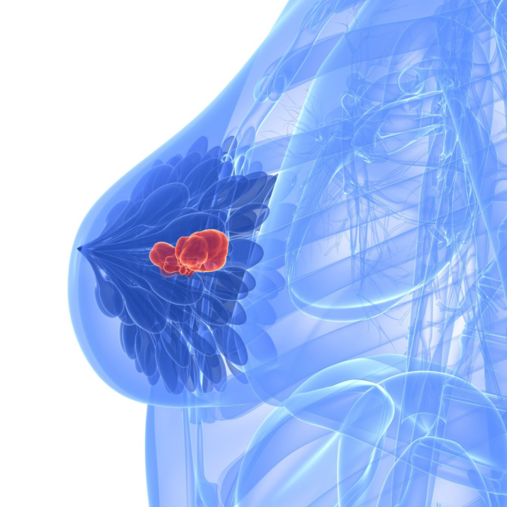 breast cancer illustration